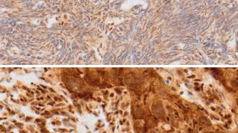 numérisation d’un marquage ADAR1 sur deux échantillons de cancer du sein triple-négatif 